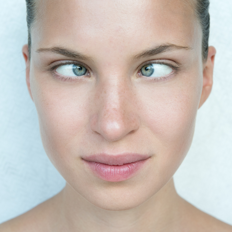 Squint Surgery